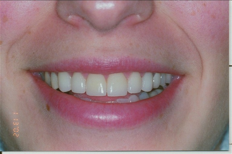 Veneers - Heather Ireland DDS